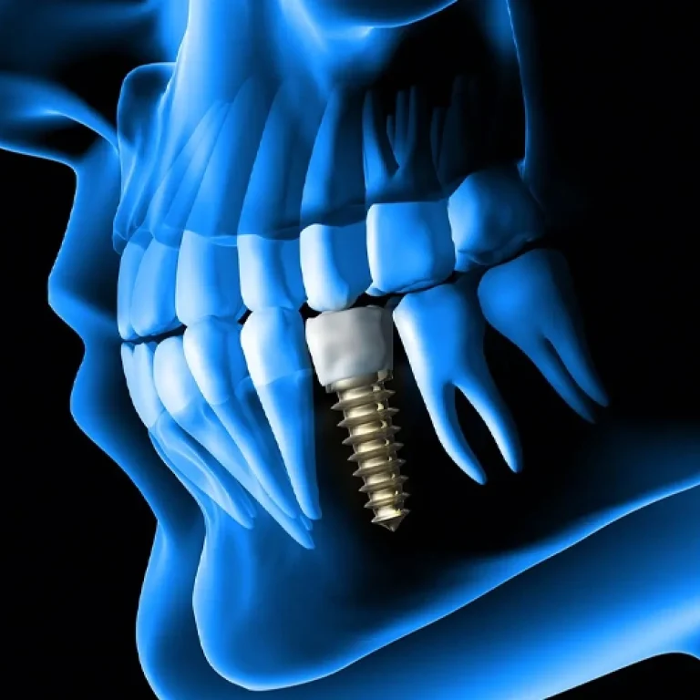 3D Guided Dental Implant Surgery