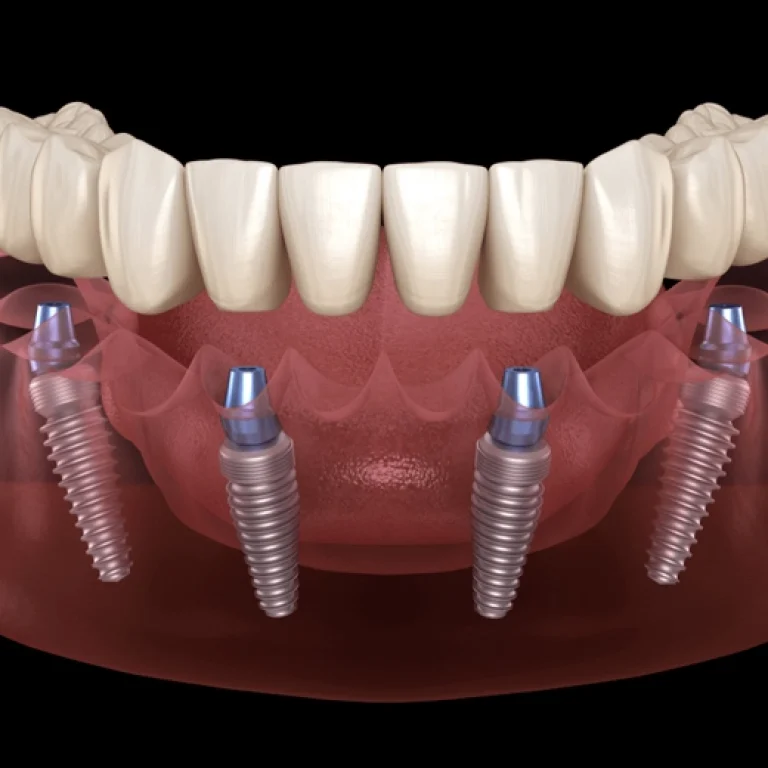 All-on-4 Dental Implants