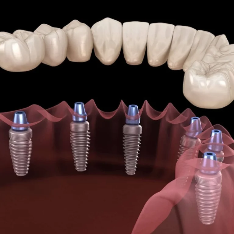 All-on-6 Dental Implants