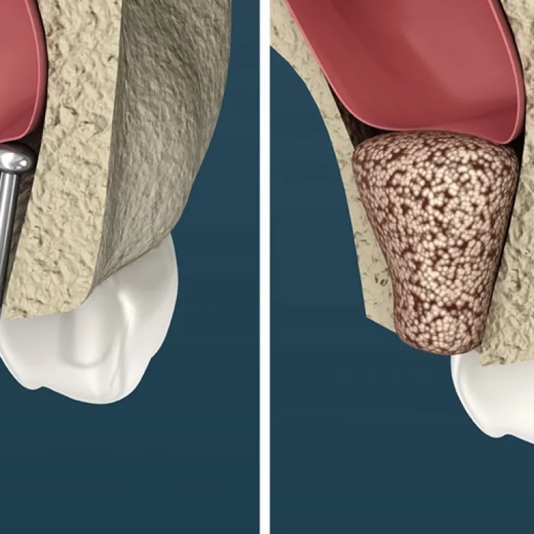 Bone Graft & Sinus lift