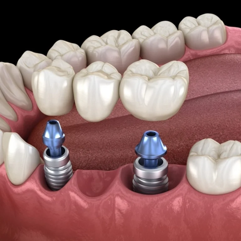 Implant Bridge
