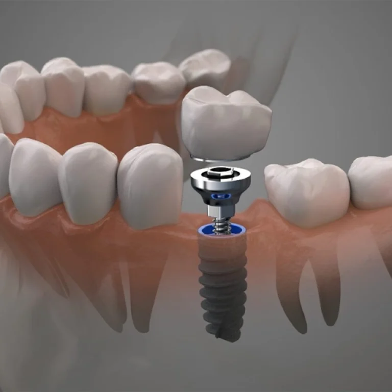 Single Tooth Implant